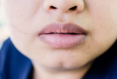 cara menghilangkan bibir hitam