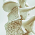 penyakit osteoporosis