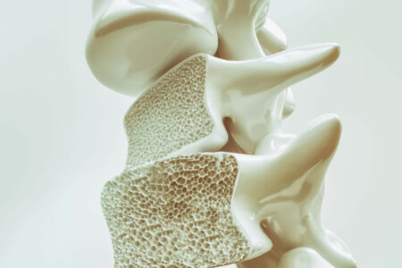 penyakit osteoporosis