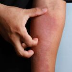 Penyakit kulit dermatitis