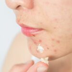 rekomendasi obat jerawat ampuh