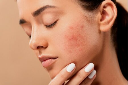 rosacea adalah