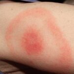 lyme disease adalah