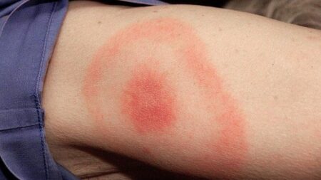 lyme disease adalah